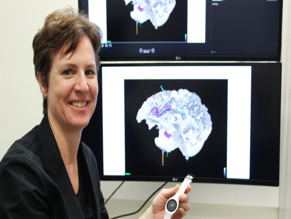 Smartwatch study explores better living with epilepsy