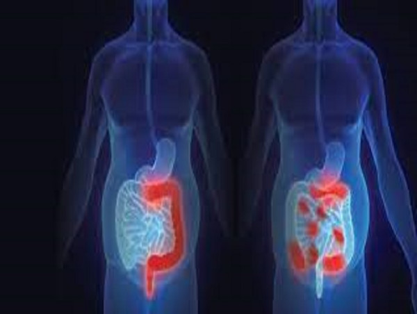Crohn's Disease Market Size To Hit US$ 11,567.8 Million By 2033 | IMARC Group