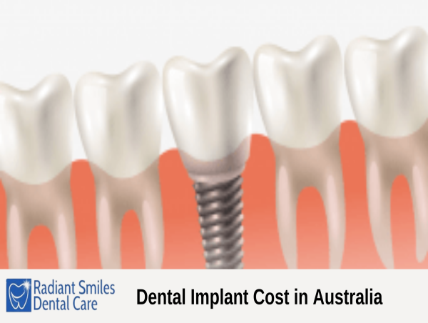  Radiant Smiles Dental Care Shares Guide on Implant Costs in Australia 