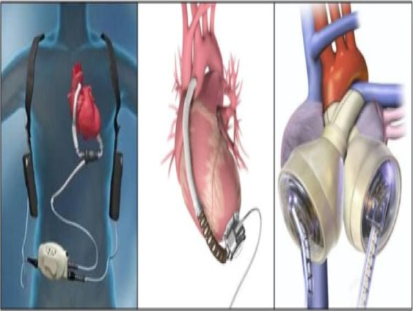  Ventricular Assist Devices Market Is Booming Worldwide 2023-2030 | Abiomed, Inc., Medtronic plc, ReliantHeart, Abbott 