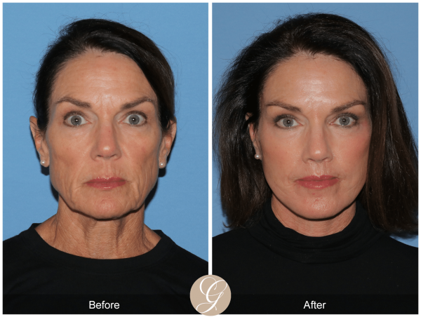 Preservation Facelift the Next Generation of Deep Plane Facelift Technique