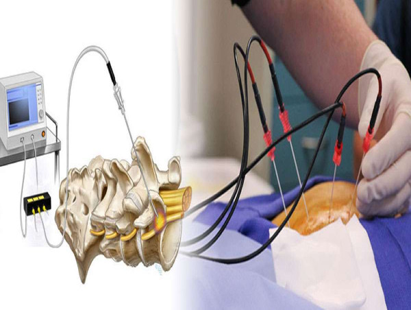  Radiofrequency Ablation Devices Market Boosted Revenue, Business Experts, Market Value Analysis, Size, Share| NeuroTherm 