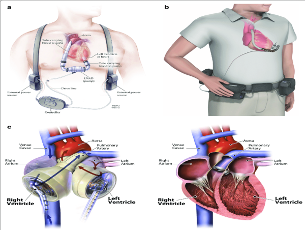 Cardiac Assist Devices Market Up-To-Date Development Data And Industry Trends Forecast From 2023 to 2030
