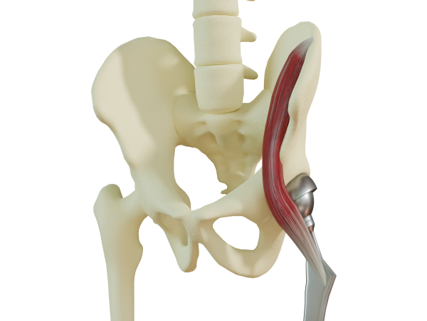 Optimisation of hard-soft material interfaces: A 3D printed imitation of bone-tendon connections