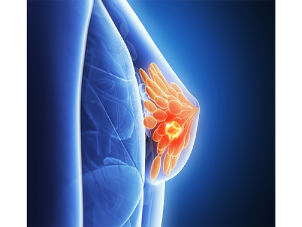  Metastatic HER2-Positive Breast Cancer Market Report 2023-2033 | Industry Size, Growth and Latest Insights 