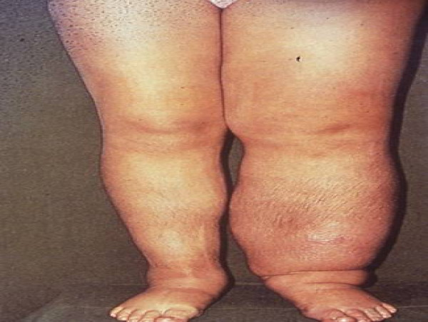  Lymphedema Self-Care: The Role of Various Exercise Modalities in the Treatment of Lymphedema 