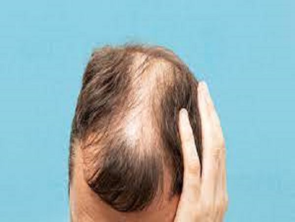 Androgenetic Alopecia Market to Reach US$ 10,717.6 Million by 2033 | CAGR of 5.6%