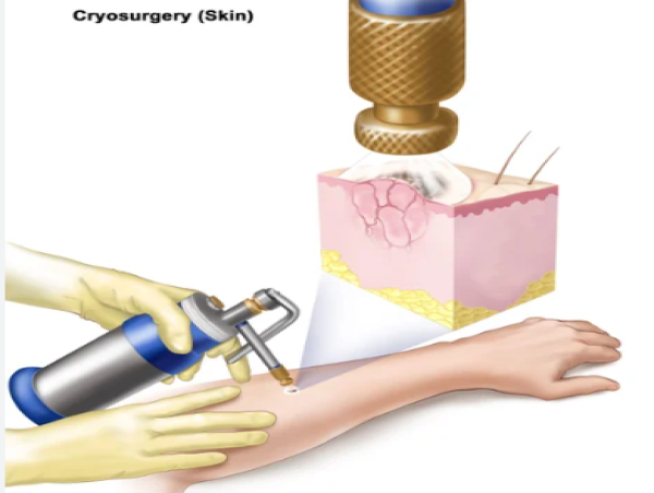  Asia Pacific Cryosurgery Market Growth Insights, Trends, Market Size and Industry Forecast, 2023-2032 