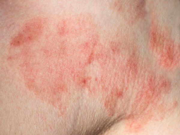 Lyme Disease Market Size, Trends, Industry Forecast and Latest Insights Till 2033