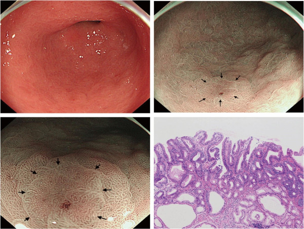  Narrow-band imaging at low magnification can detect lesions overlooked by white-light imaging 