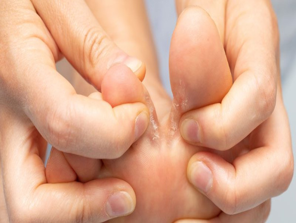 Athlete’s Foot Market is Projected to Grow at a CAGR of 2.32% from 2023-2033 | IMARC Group