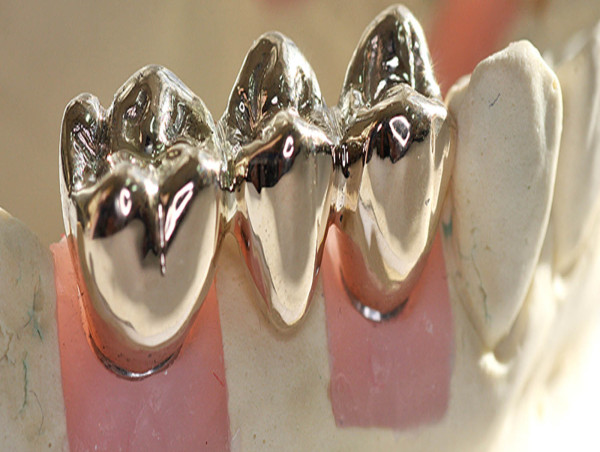 Stainless Crowns Market See Incredible Growth 2023-2030 with Scope, Value, Size |Dentsply Sirona, Ivoclar Vivadent, 3M