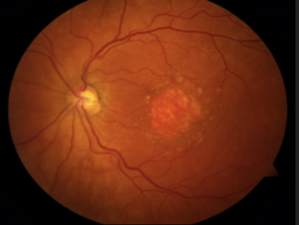 Geographic Atrophy Market to Reach US$ 44.5 Billion by 2034, at CAGR of 5.7% from 2024 to 2034, IMARC Group