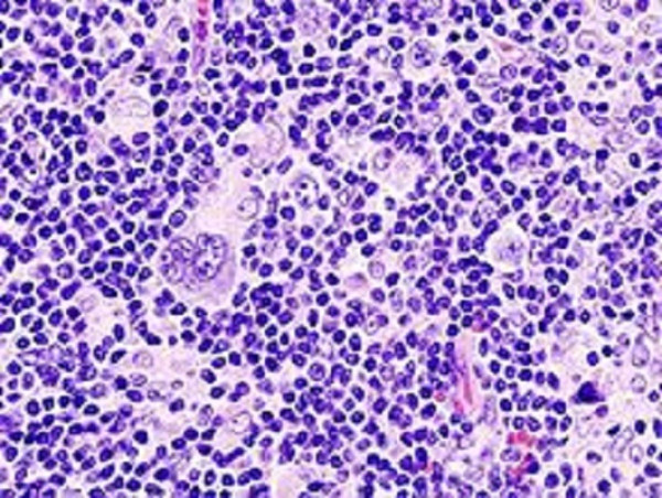 Hodgkin’s Lymphoma Market to Reach US$ 18.9 Billion by 2034 | IMARC Group