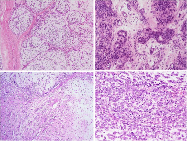 Projected Growth of 6.32% CAGR in the Soft Tissue Neoplasms Market from 2024 to 2034 | IMARC Group