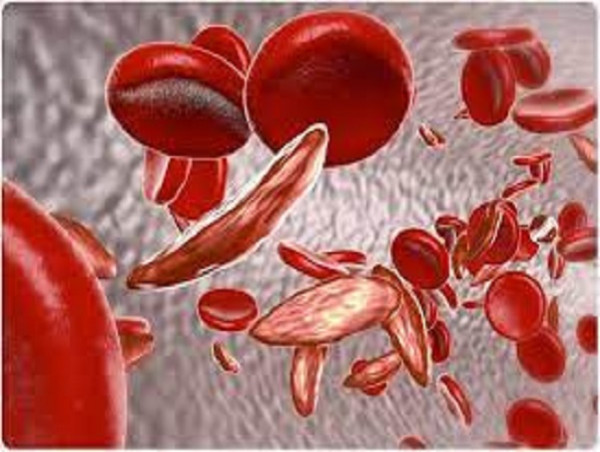 Sickle Cell Disease Market to Reach US$ 1,904.2 Million by 2034, at CAGR of 8.5% from 2024 to 2034, IMARC Group
