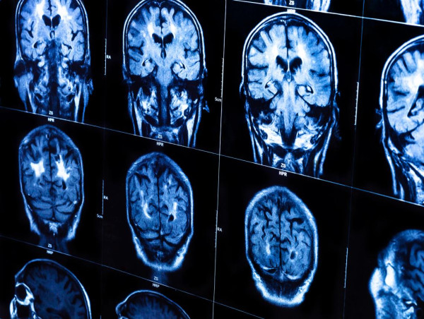  Mild Cognitive Impairment Market is Projected to Grow at a CAGR of 4.02% from 2024-2034 | IMARC Group 