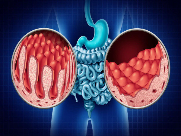 Celiac Disease Market to Reach US$ 1,362.1 Million by 2034 | IMARC Group