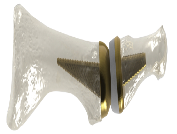  AddUp and Anatomic Implants Announce FDA 510(k) Submission for the World’s First 3D Printed Toe Joint Replacement 
