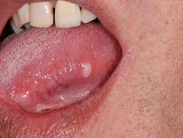 Mouth Neoplasms Market is Projected to Grow at a CAGR of 3.69% from 2024-2034 | IMARC Group