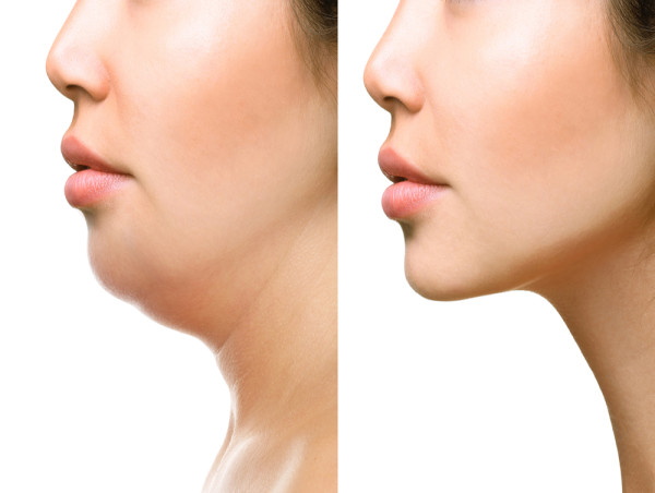 Enhancing Facial Aesthetics: Insights into the Facial Implants Market Potential Growth 2024 -2031, Industry Analysis