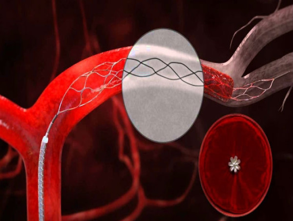  Clot Management Devices Market Industry Analysis 2024 Future Scope, Trends with Top Companies by 2031 |Medtronic, Inc 