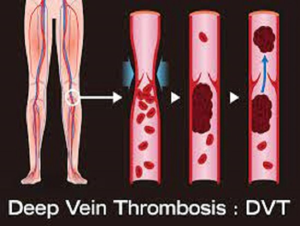 Deep Vein Thrombosis Market to Reach US$ 905.9 Million at CAGR of 6.38% from 2024 to 2034