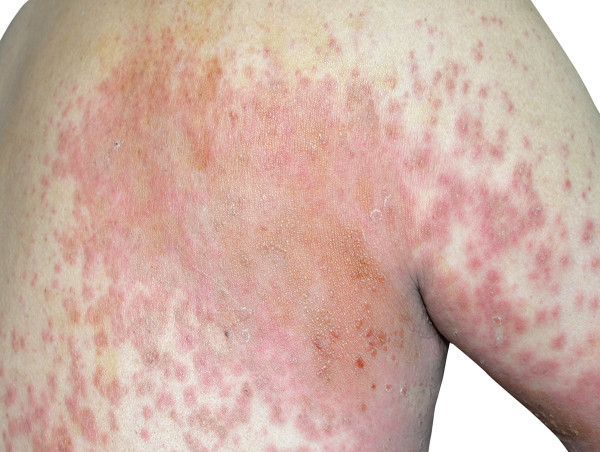 Atopic Dermatitis Market Share, Epidemiology, Analysis & Trends 2024-2034
