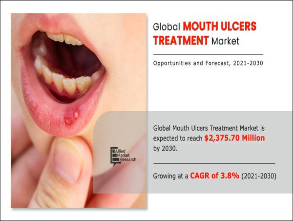  Global Mouth Ulcers Treatment Market to Reach $2.37 Billion by 2030: Allied Market Research 