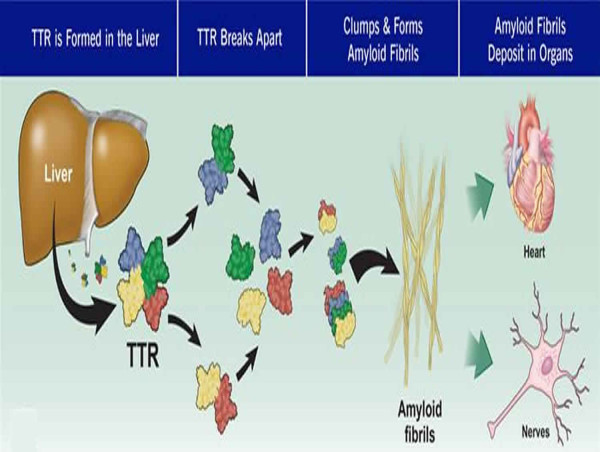  Transthyretin Amyloid Cardiomyopathy Treatment Market Poised for Robust Growth by 2031: Pfizer Inc., GlaxoSmithKline Plc 