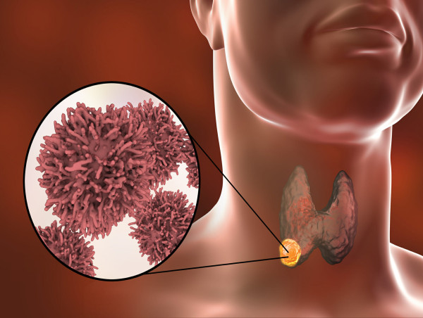Medullary Thyroid Cancer Market Size, Growth, Forecast & Trends 2024-2034