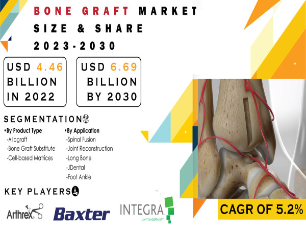 Bone Graft Market Size & Share Analysis, Trends, Growth, Challenges, Business Overview, Forecast 2030
