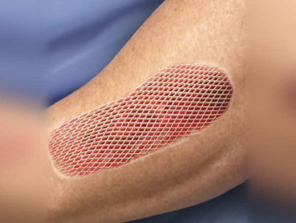 Global Skin Grafting Device Market Size to Surpass US$ 1,519.0 Million by 2030 | Exhibiting a CAGR of 7.1%