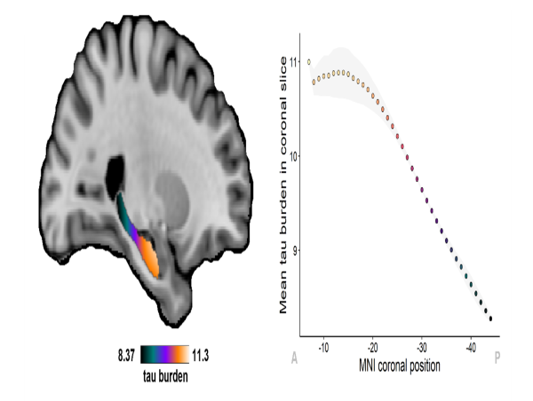  Mapping microscopic pathology of Alzheimer's disease in 3D 