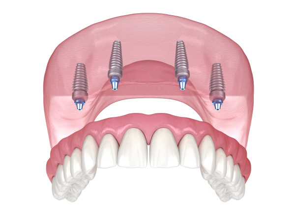  Radiant Smiles Dental Care Announces All On 4 Dental Implants in Perth 