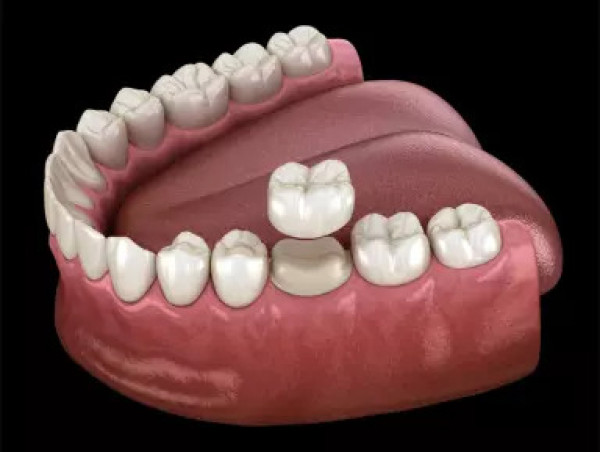 My Emergency Dentist Launches Emergency Root Canal Services in Perth