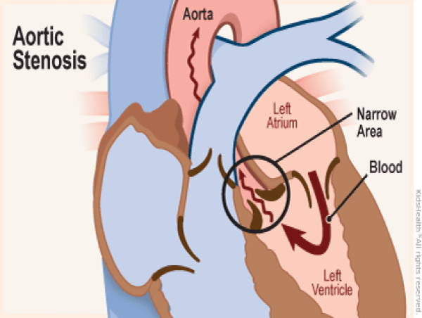  Aortic Stenosis Market Comprehensive Study Explores Huge Growth in Future: Abbott, Artivion, Medtronic 