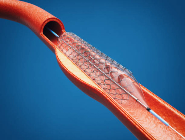  India Coronary Stent Market Expected to Expand at a Steady 2024-2031 |Abbott Laboratories, Medtronic, Inc,Biosensors Inc 