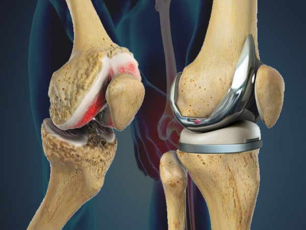  Knee Replacement Market Is Booming Worldwide 2024-2031 | Zimmer Biomet, Stryker Corporation, Smith & Nephew Plc. 