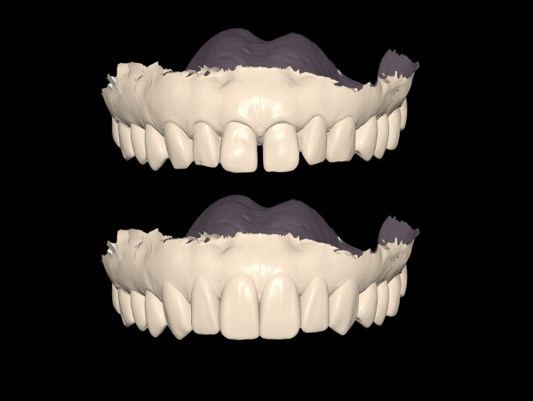 Digital Esthetic Designs Announces Advanced Digital 3D Wax-Up Services