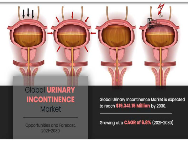 Urinary Incontinence Market Size, Share, Competitive Landscape and Trend Analysis Report Forecast - 2023-2030