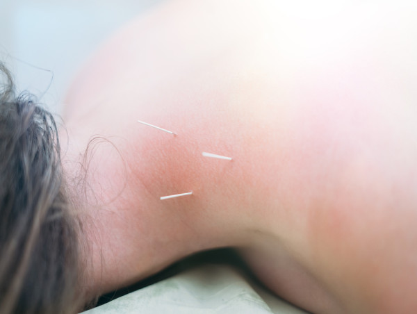 Introducing Dry Needling for Effective Treatment of Musculoskeletal Conditions