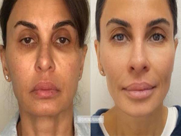  Dr. Simon Ourian Reviews Facelift Surgery: The Pros and Cons of Surgical vs. Non-Surgical Facelifts 