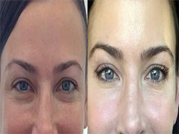  Dr. Simon Ourian Reviews Surgical and Non-Surgical Eyelid Lifts and Dark Circle Removal. 