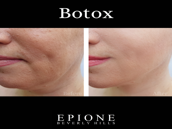  Dr. Simon Ourian Reviews Botox Injections: Smoothing Out Wrinkles 