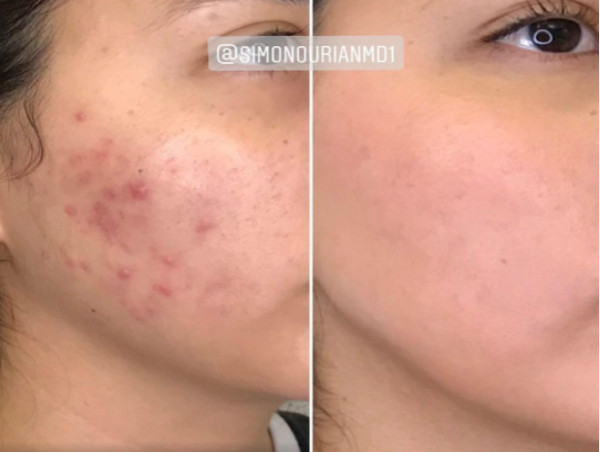  Dr. Simon Ourian Reviews Laser Skin Resurfacing: Achieving Radiant Skin 