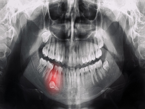  Caring for Teeth After Wisdom Tooth Removal: Expert Advice from Dr. Ronnie Deniger 