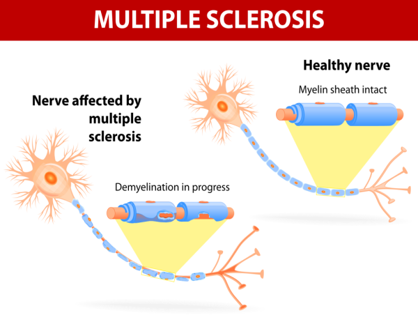 Multiple Sclerosis Therapeutics Market Projected To Witness Substantial Growth, 2024-2031:Johnson & Johnson, Sanofi S. A