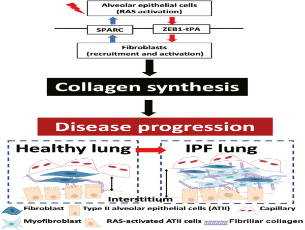 Chinese Medical Journal Pulmonary and Critical Care Medicine Study Explores Idiopathic Pulmonary Fibrosis Pathogenesis