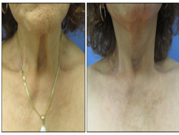  Chicago Cosmetic Surgeon Urges People to Save Money on Expensive Cosmetic Surgery by Going Local 